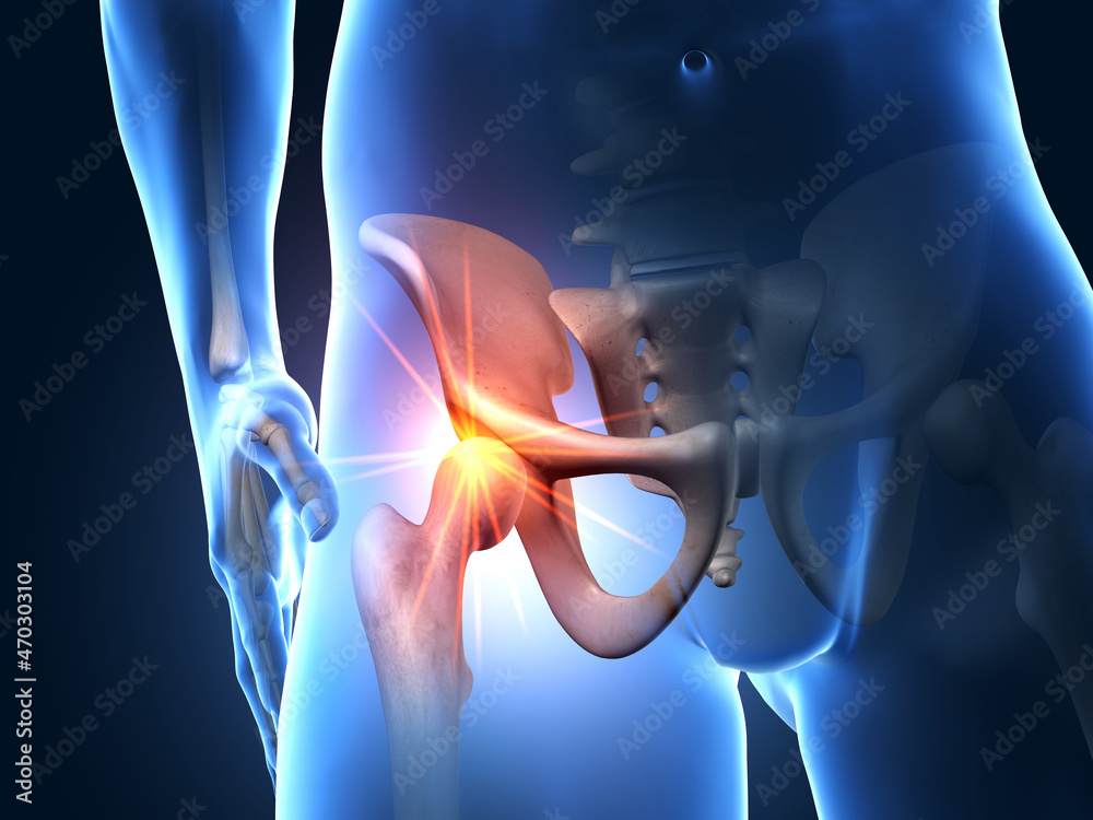 Painful hip joint, medical 3D illustration - obrazy, fototapety, plakaty 