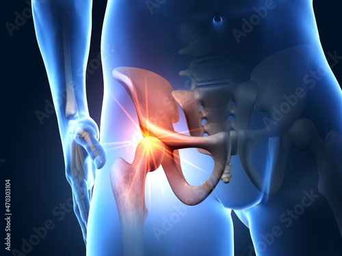 Painful hip joint, medical 3D illustration
