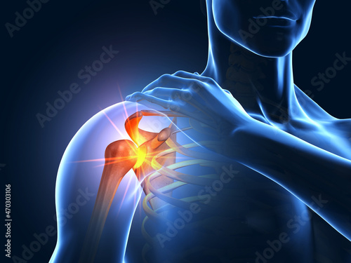 Painful shoulder joint, medical 3D illustration