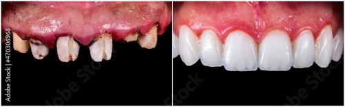 teeth restoratuons by ceramic crowns b1 color