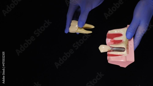Tooth extraction concept. Dentistry and teeth care concept. Dental surgical operation. Vertical video. Black background. Losing molar tooth. Dentist examine. Tooth mesial impaction with pericoronitis photo
