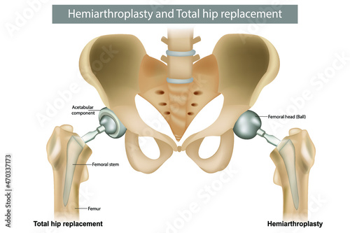 Total hip replacement components and Hemiarthroplasty. Hip Implant photo
