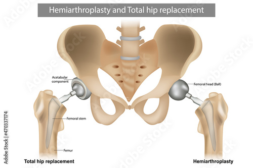 Total hip replacement components and Hemiarthroplasty. Implant