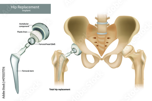 Total hip replacement components and Hemiarthroplasty. Hip Implant photo