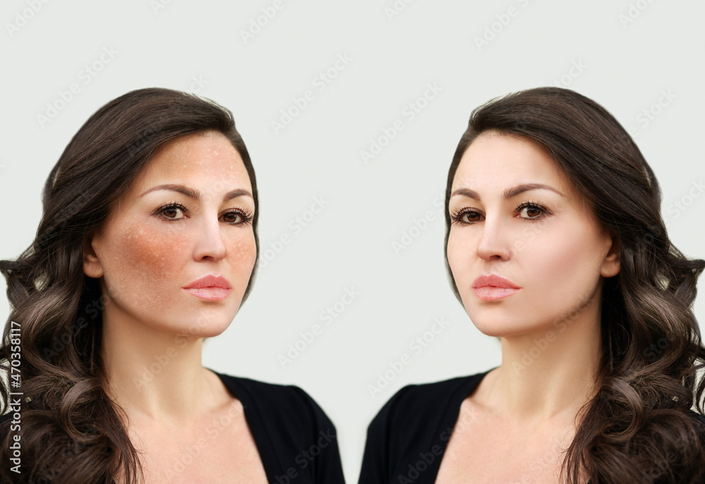 Dark spots, freckles,hyperpigmentation(melasma or chloasma). Dark spots, freckles,hyperpigmentation(melasma or chloasma).