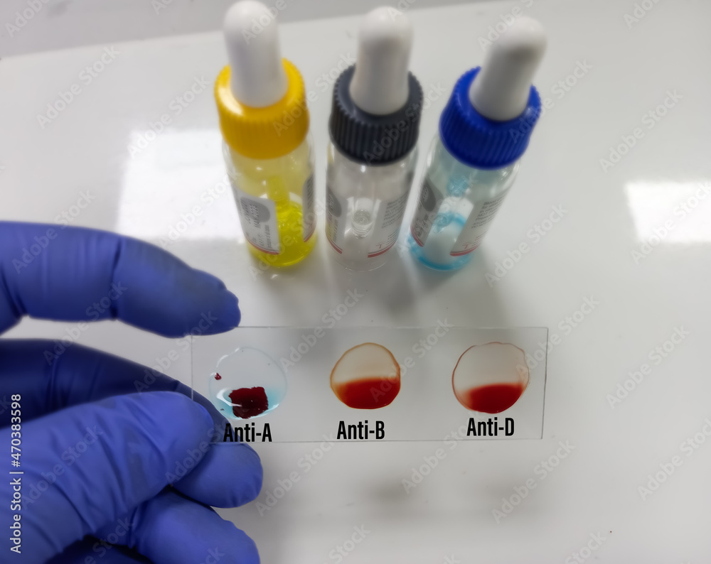 Blood group testing by slide agglutination method with reagent, A Negative blood grouping. medical concept Blood group testing by slide agglutination method with reagent, A Negative blood grouping. medical concept