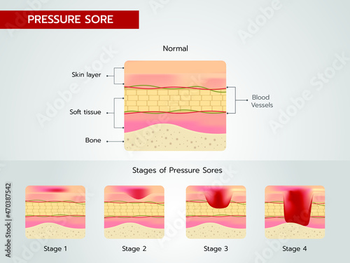 Bedsores Pressure Ulcers Stages of Pressure Sores