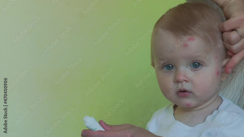 Mom's hand applies antiallergic cream to the unfocused face of a baby