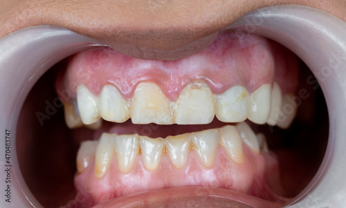 Closeup of man's teeth with  retractor for mouth. Patient at the dentist .Tooth disease.  Carious. Before the treatments photo