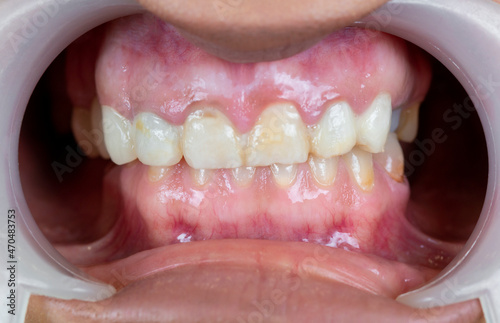 Closeup of man's teeth with retractor for mouth. Patient at the dentist .Tooth disease. Carious. Before the treatments