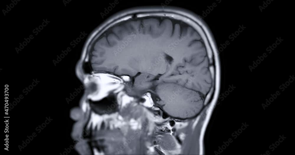 MRI of the brain or magnetic resonance imaging of the brain showing brain anatomical.. MRI of the brain or magnetic resonance imaging of the brain showing brain anatomical..