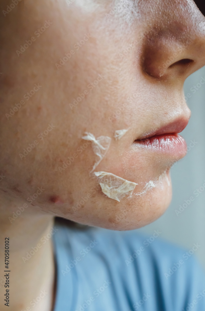 Woman's face after chemical peeling. Peeling skin on the face