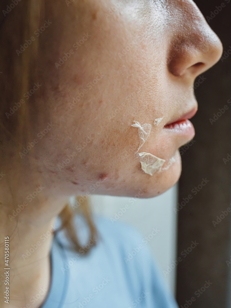 Woman's face after chemical peeling. Peeling skin on the face