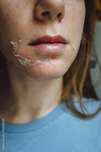 Woman's face after chemical peeling. Peeling skin on the face. Exfoliation of old skin problems, acne, blackheads.