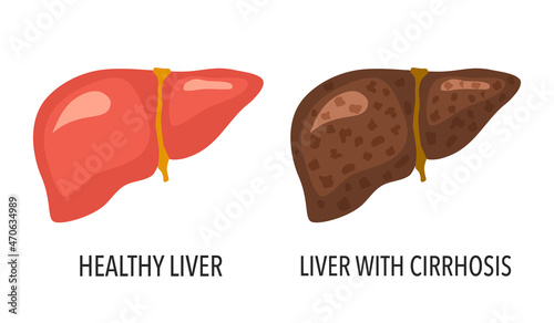 Comparison of healthy liver and liver cirrhosis disease. Human liver organ anatomy vector illustration on white background.