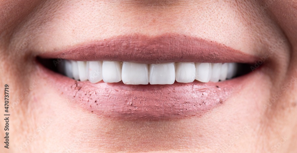 Naklejka premium teeth indirect restoration by ceramic crowns and veneers