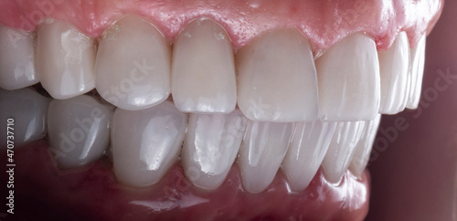 teeth indirect restoration by ceramic crowns and veneers