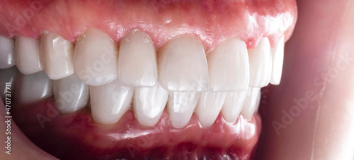 teeth indirect restoration by ceramic crowns and veneers