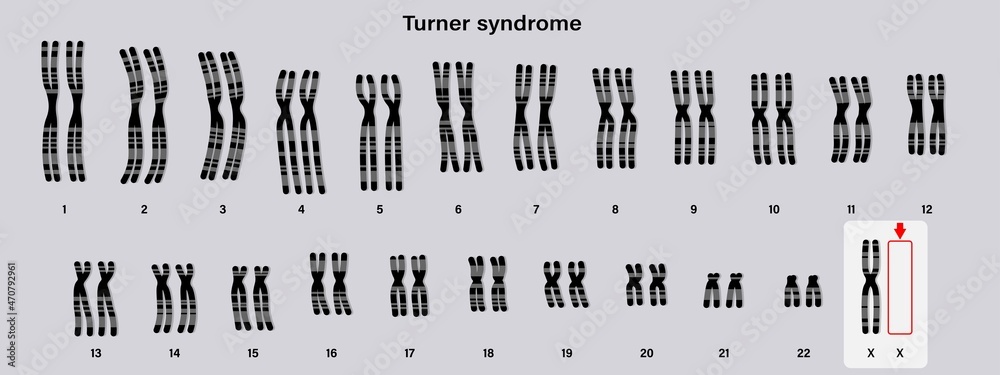 Human Karyotype Of Turner Syndrome One Of The X Chromosomes Sex