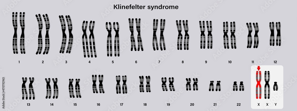 Human Karyotype Of Klinefelter Syndrome Klinefelters Ks Or Xxy Vector De Stock Adobe Stock 4137