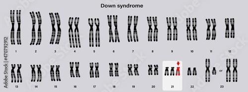 Human karyotype of Down syndrome. Autosomal abnormalities. Trisomy 21. Genetic disorder.