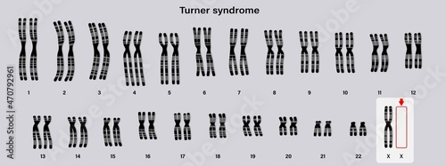 Human karyotype of Turner syndrome. One of the X chromosomes (sex chromosomes) is missing or partially missing. 45,X, or 45,X0. photo