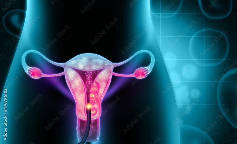 Dilation and curettage (d and c).endometrial biopsy.cervical cancer.3d