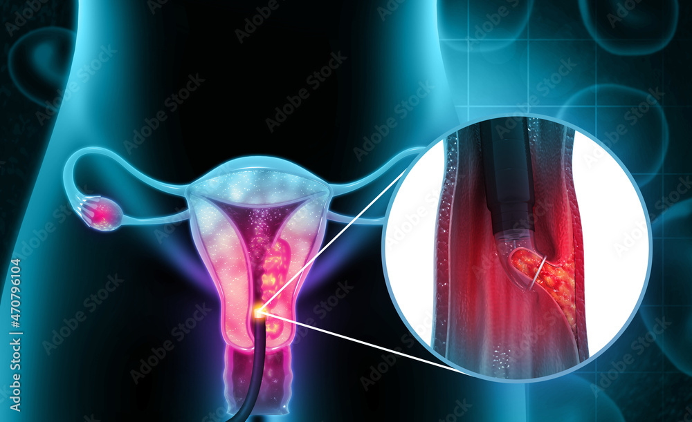 Dilation and curettage (d and c).endometrial biopsy.cervical cancer.3d illustration Stock