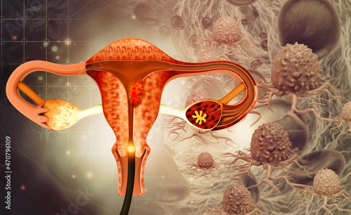Dilation and curettage (d and c).endometrial biopsy.cervical cancer.3d illustration photo