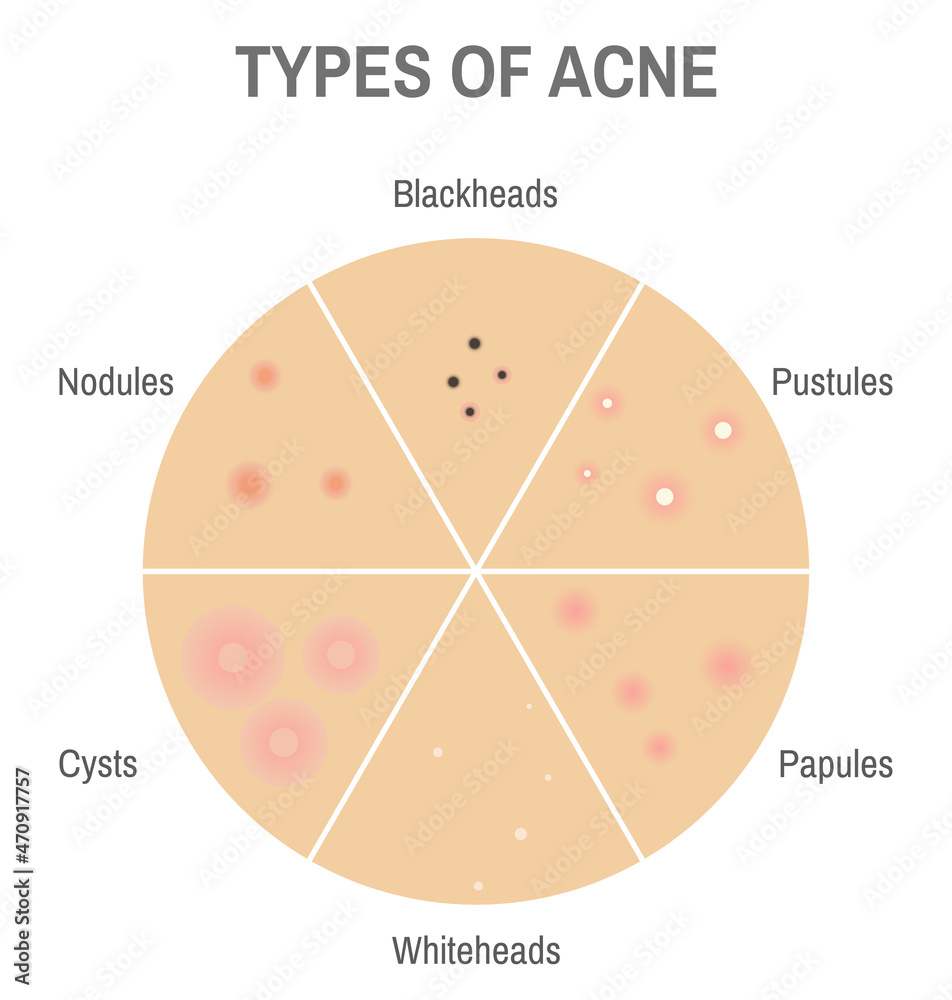 Types of acne. Circle diagram infographic of skin conditions for ...