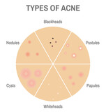 Types of acne. Circle diagram infographic of skin conditions for medical articles, posters and banners.	