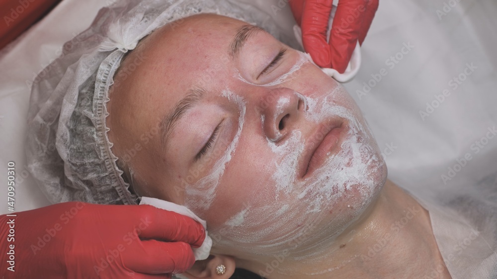 Wipe the mask off the face of a girl with problematic koja with cotton pads. Wipe the mask off the face of a girl with problematic koja with cotton pads.
