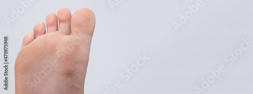 wart, papilloma on a feet. Macro shot, selective focus, close-up, space for text. Dermatological problems with the skin