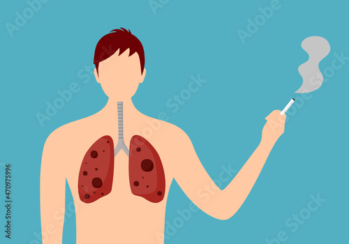 Man smoking with damaged lung in flat design. Stop smoking campaign. Lung cancer disease. World no tobacco day.