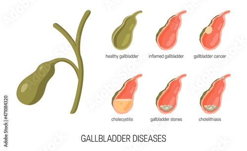 Gall bladder diseases in cartoon style, vector