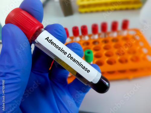 Biochemist hold blood sample for the testing of serum ADA level. Adenosine deaminase. photo
