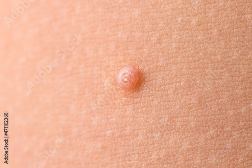 Detail of a molluscum contagiosum nodule produced by the Molluscipoxvirus virus on the skin of the abdomen of a child. photo
