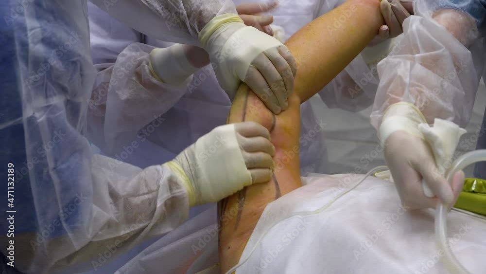 A surgeon removes fat from a woman's arm during liposuction surgery. The doctor massages the arm before pumping out fat for liposuction. Surgery. Plastic surgery. A surgeon removes fat from a woman's arm during liposuction surgery. The doctor massages the arm before pumping out fat for liposuction. Surgery. Plastic surgery.