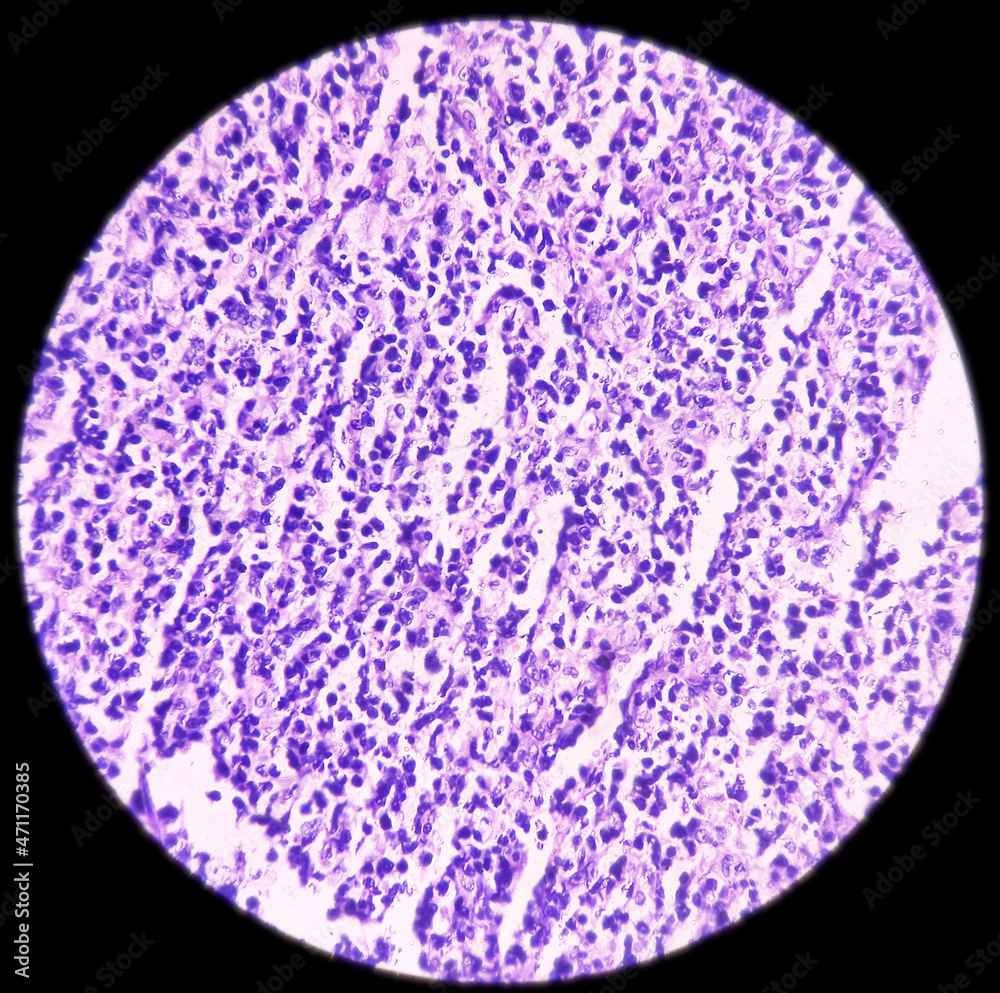 Inguinal lymph node: Non-Hodgkin's lymphoma,high grade, reveals ...