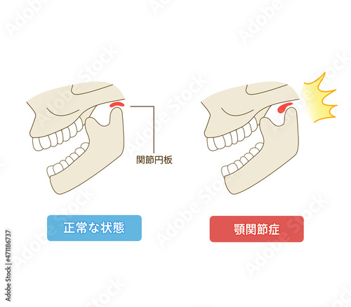 顎関節症の仕組みのイラスト