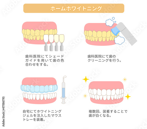 ホームホワイトニング　歯のホワイトニングのイラスト