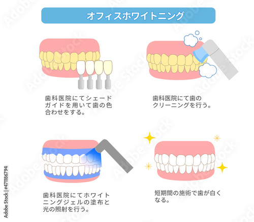 オフィスホワイトニング　歯のホワイトニングのイラスト