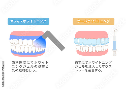 ホームホワイトニングとオフィスホワイトニングの違いのイラスト