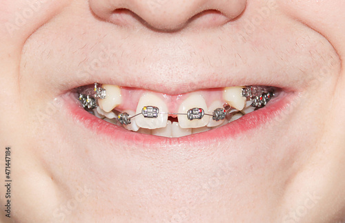 Young man showing crooked growing teeth after visiting the dentist and installing braces