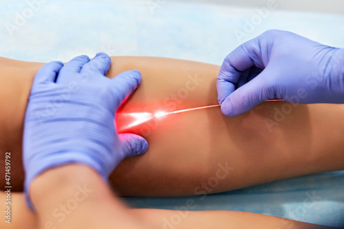 Varicose laser treatment on female legs in clinic