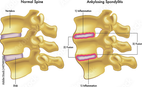 Medical illustration compares a normal spine with one showing the steps leading to ankylosing spondylitis.
