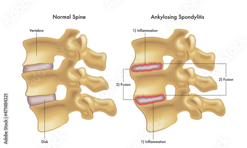 Medical illustration compares a normal spine with one showing the steps leading to ankylosing spondylitis. photo