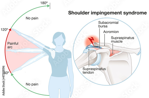 Obraz na płótnie Shoulder impingement. Painful arc. Labeled illustration