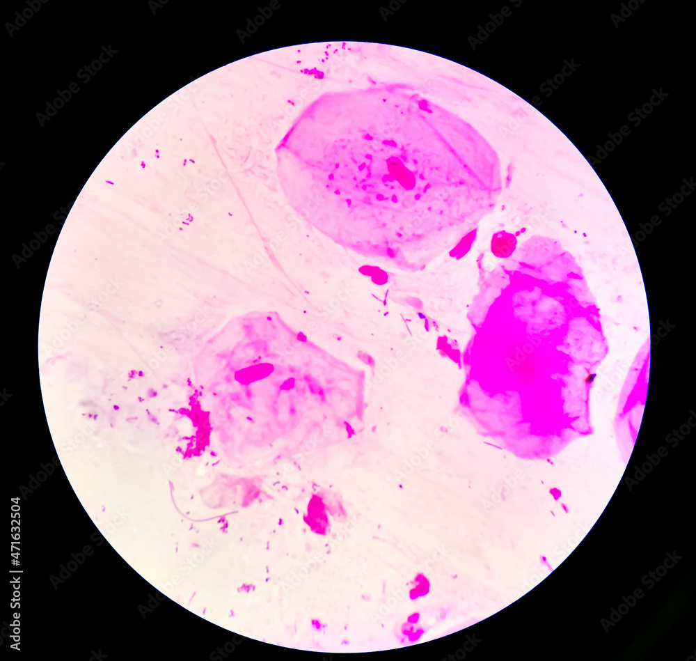 High Vaginal Swab (HVS) gram stained microscopic 100x zooming show gram