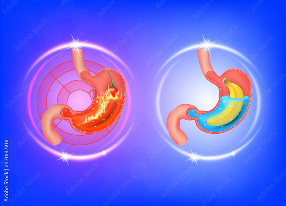 Healthy and sick stomach. Peppers and bananas in the stomach. Stomach heartburn. Gastritis, acid